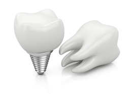 You’ll Be Relieved to Know Insurance Coverage for Dental Implants