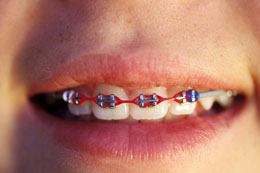 Braces Pain Remedies