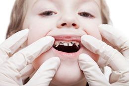 Tooth Decay in Children