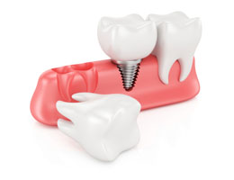 Mini Dental Implants