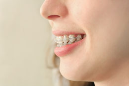 Ceramic Braces