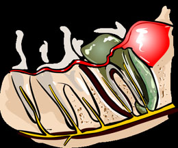 Tooth Infection after Filling