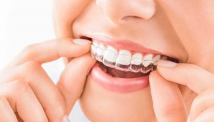 Invisalign Vs Braces