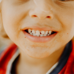 Underbite in Children