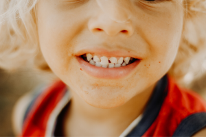Underbite in Children