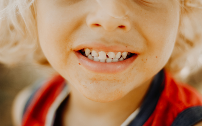 Underbite in Children