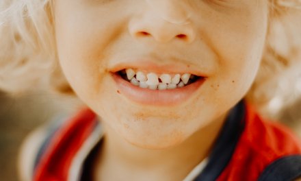 Underbite in Children